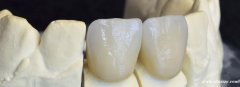深圳义齿加工厂 诚邀海外华人各位牙科医生，牙科技师，牙诊所和